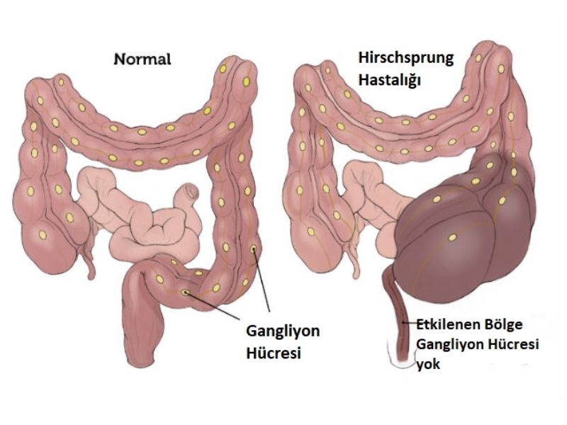 hirschsprung-hastaligi