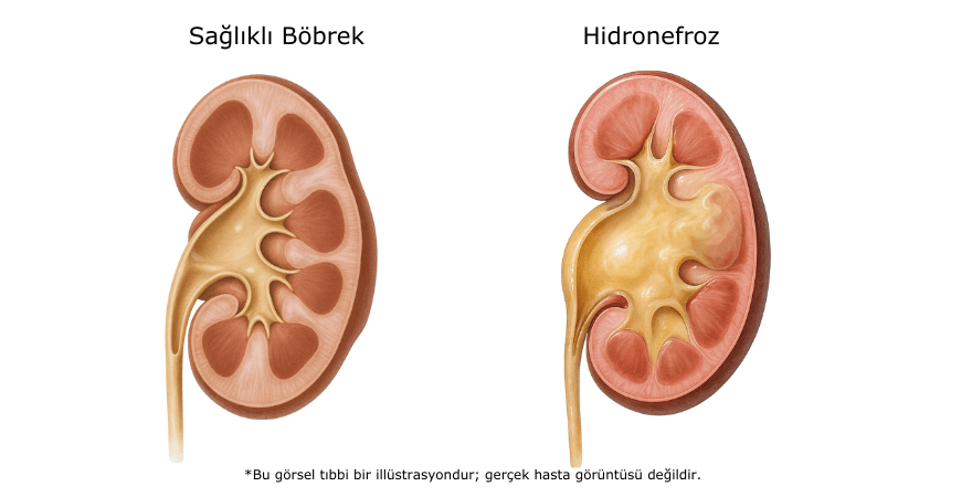 cocuklarda-kasik-fitigi-tedavisi